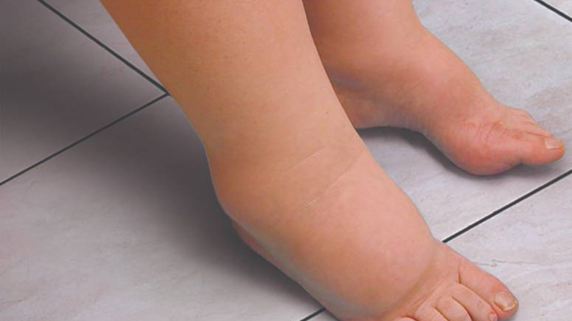Lymphedema 2